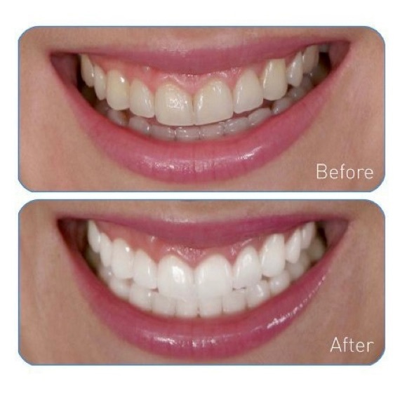 Go Smile Teeth Whitening Gel NIB 3.4 oz - Picture 5 of 9